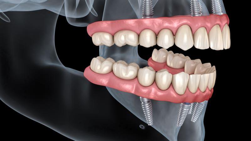 Illustration of All-on-4 implants in upper and lower dental arches