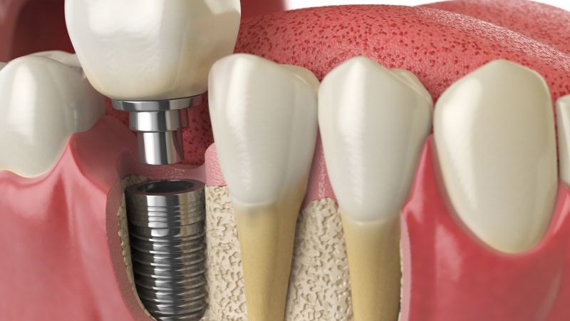 Illustration of traditional dental implant next to natural teeth