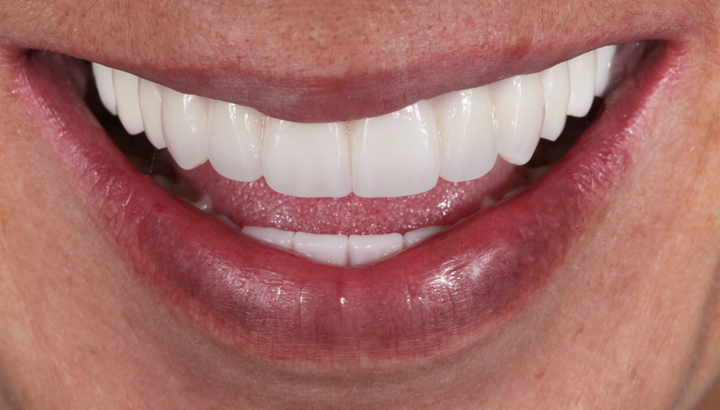 Close up of flawless smile thanks to treatment at Boston dental office