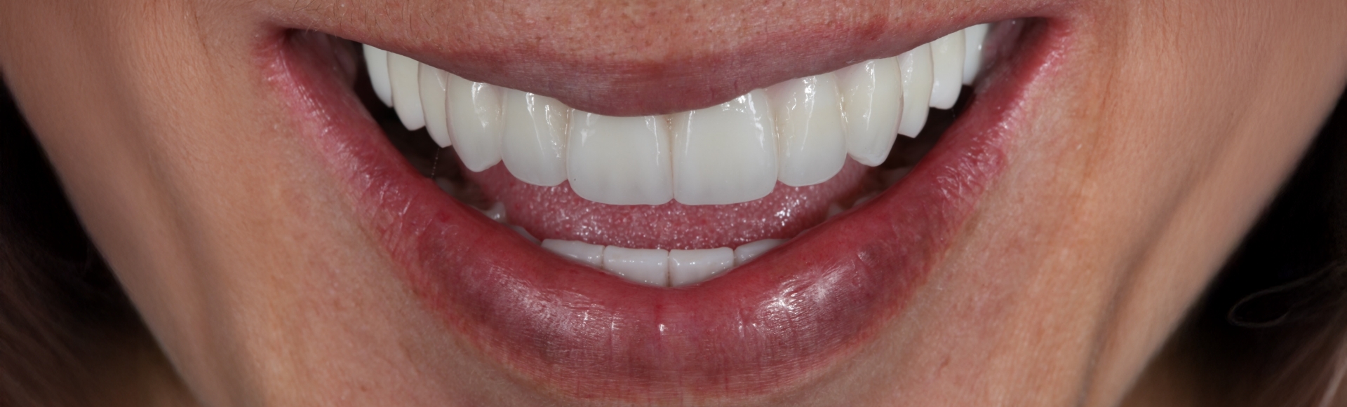 Close up of flawless smile thanks to treatment at Boston dental office