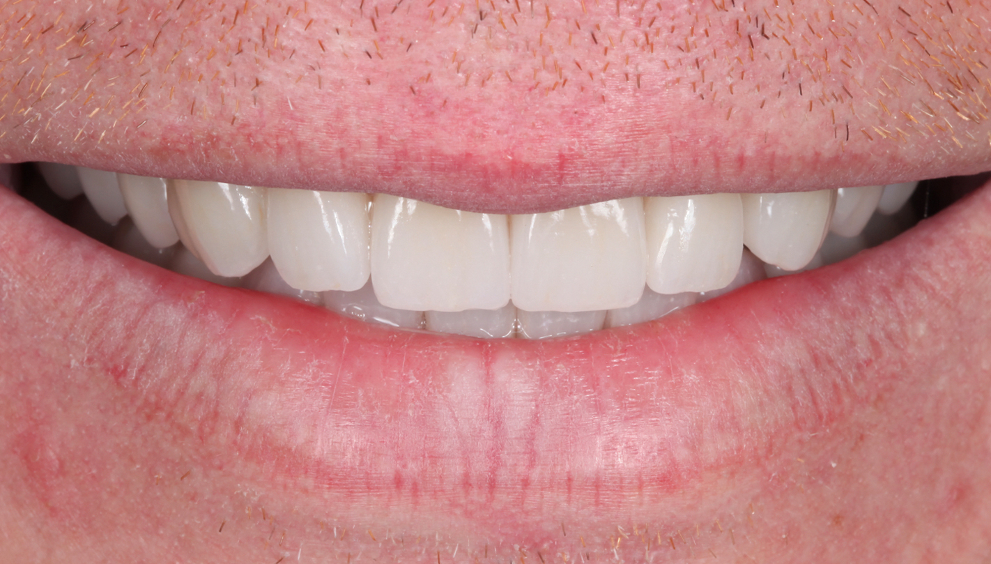 Close up of smile with flawless teeth after full mouth reconstruction in Boston
