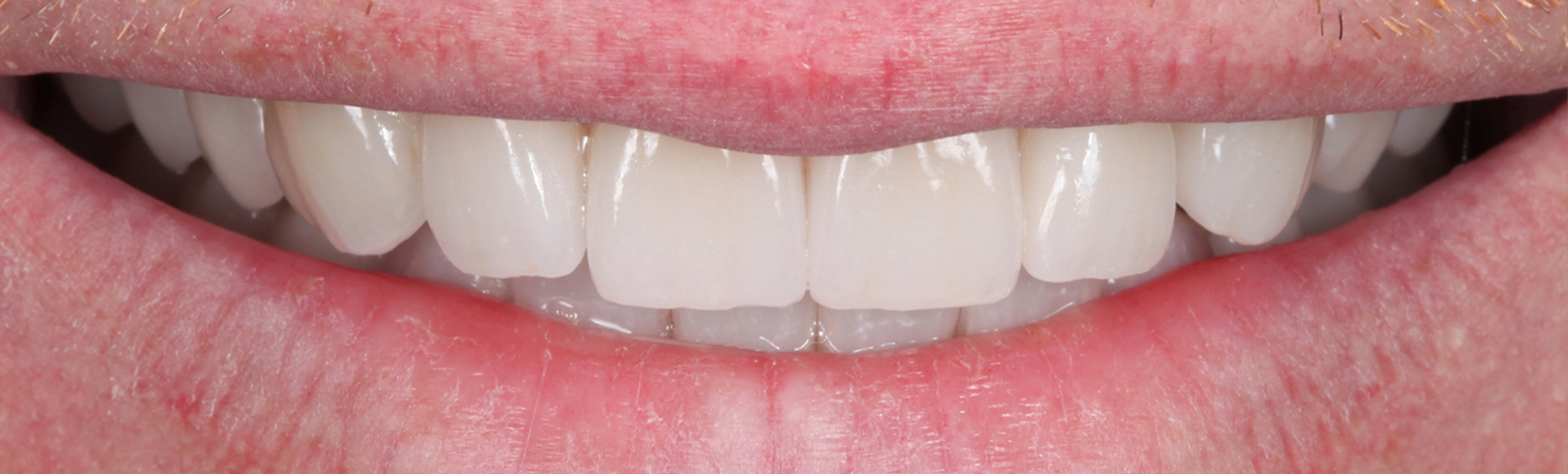 Close up of smile with flawless teeth after full mouth reconstruction in Boston