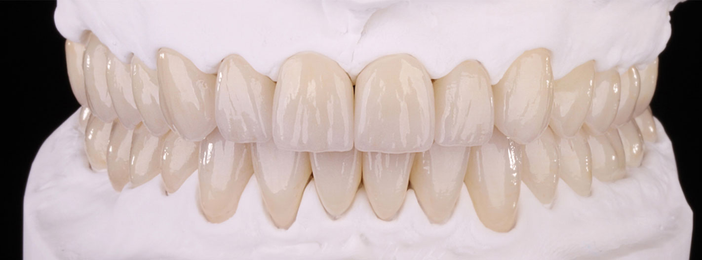 Model of teeth made using advanced dental technology in Boston