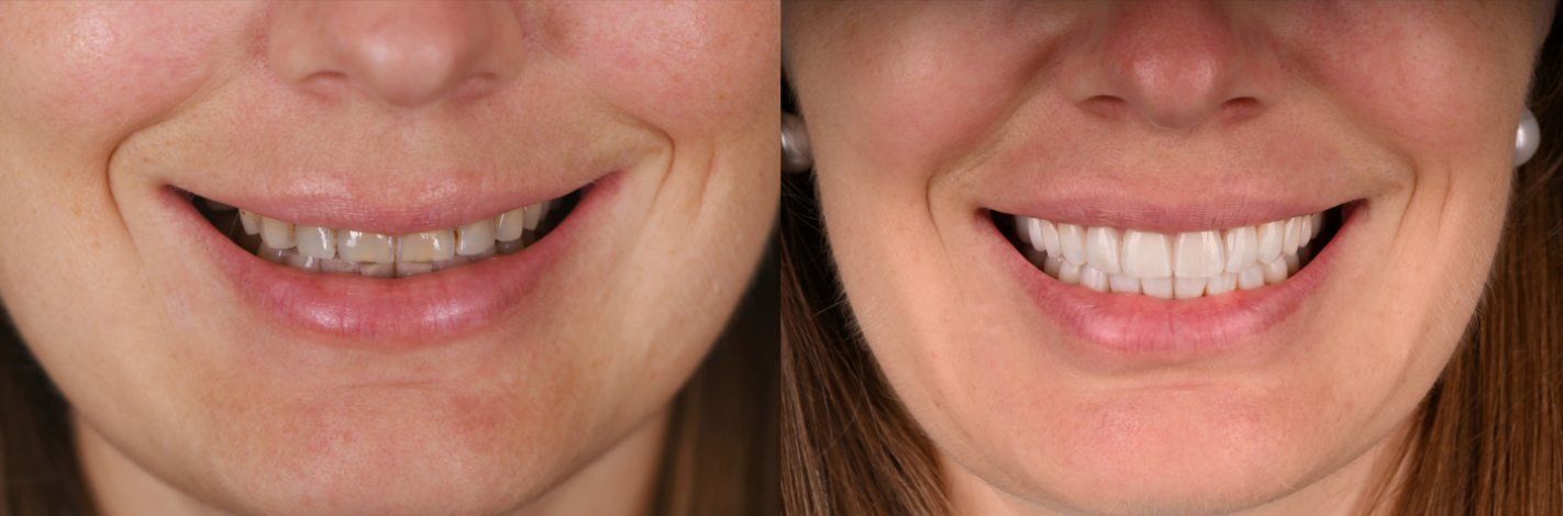 Close up of smile before and after treatment from Boston dentists