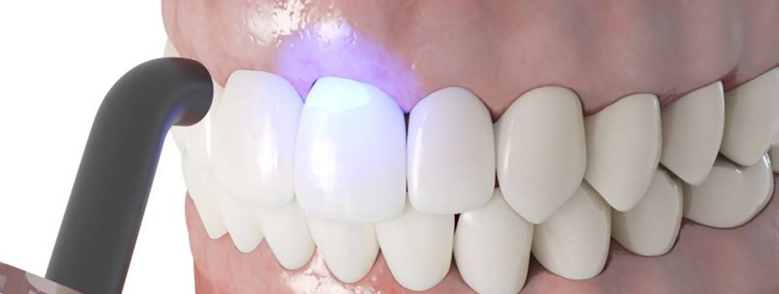 Illustration of curing light being used to harden dental bonding