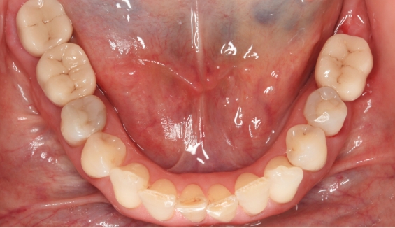 Lower row of teeth with ceramic dental implants restored with dental crowns