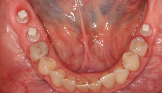 Lower row of teeth with a few ceramic dental implants
