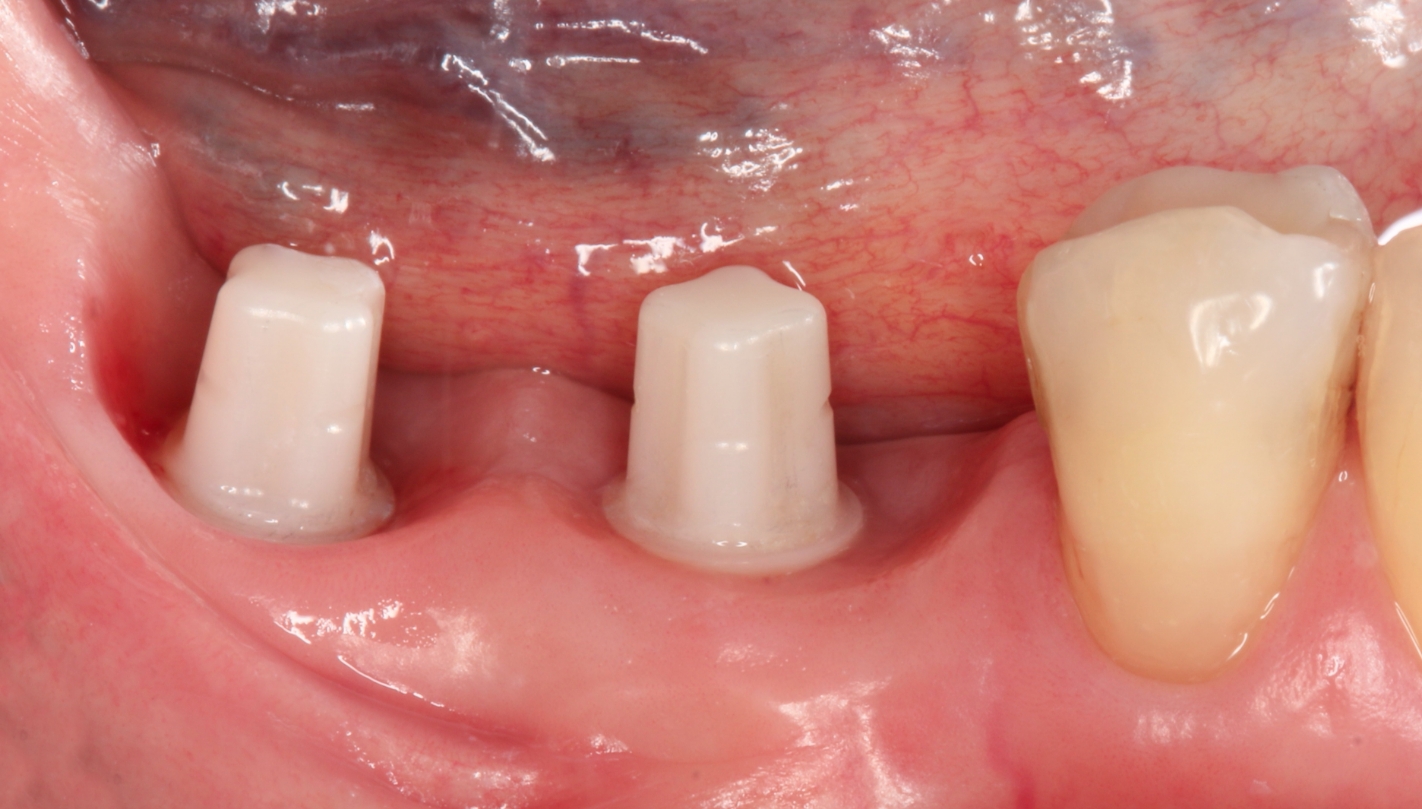Close up of mouth with several ceramic dental implants in Boston