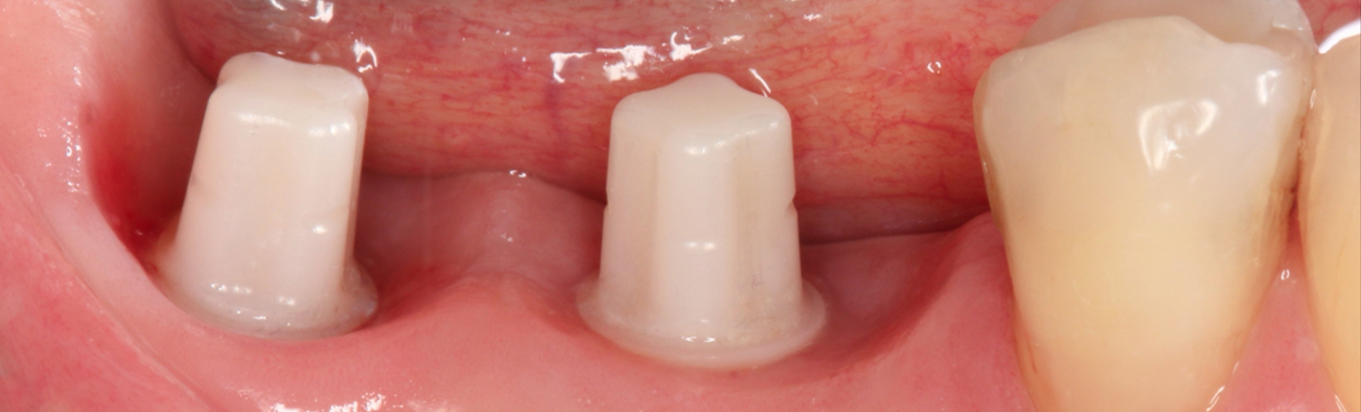 Close up of mouth with several ceramic dental implants in Boston