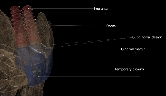 Digital model of a dental implant in the jaw with the parts of it labeled
