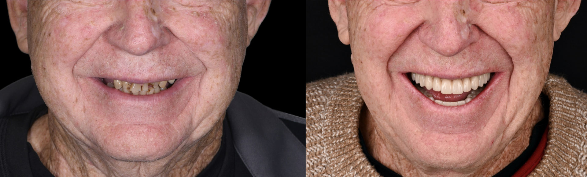 Close up of senior smiling before and after getting dental implants in Boston