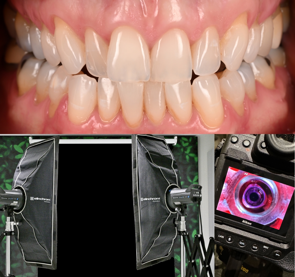 Collage featuring close up photo of teeth and professional photography equipment