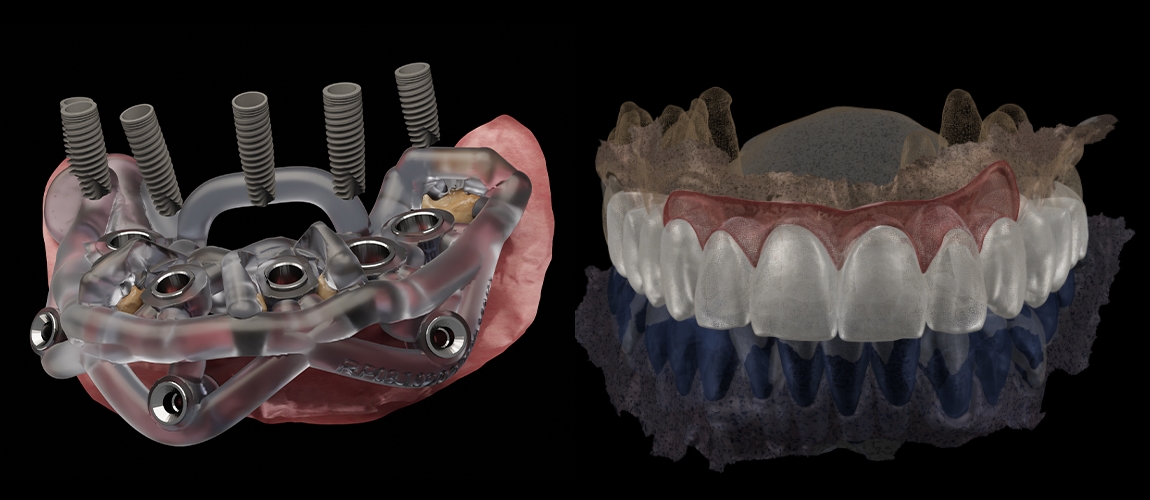 Two digital models of a mouth with dentures