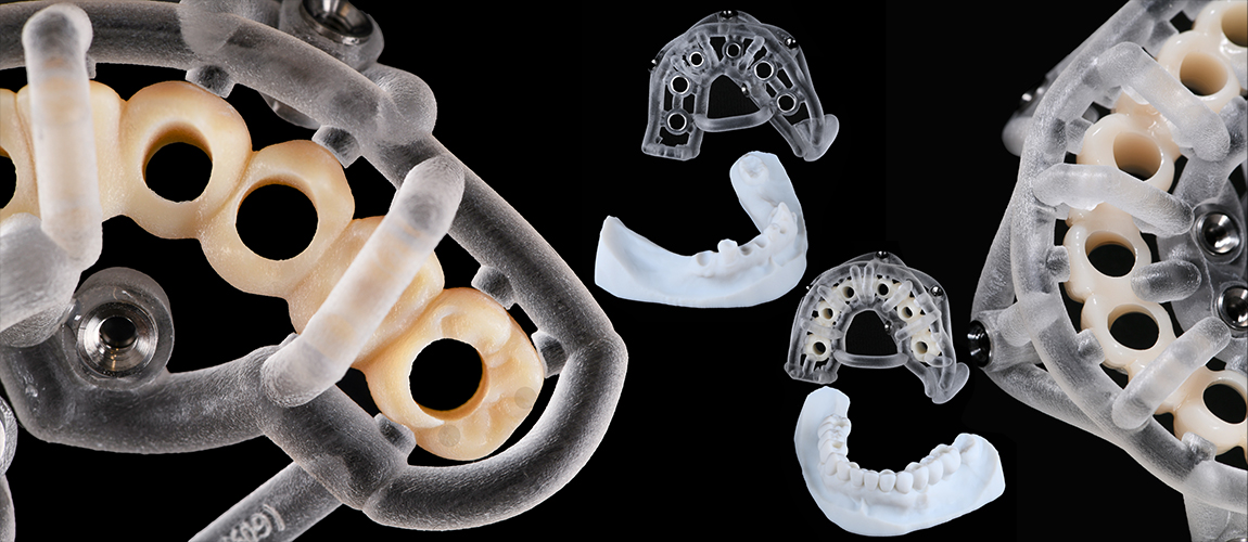 Collage of several 3 D printed dental devices