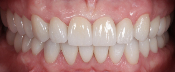 Close up of mouth full of pristine white teeth