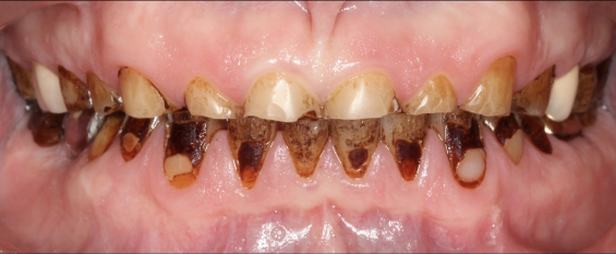 Close up of mouth with severely decayed and damaged teeth