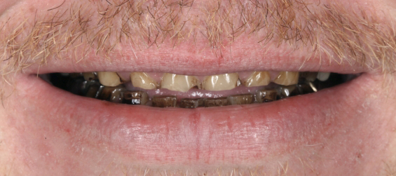 Mouth with several damaged teeth and metal restorations