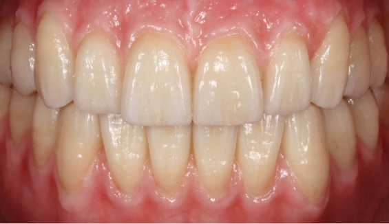 Mouth after correcting damaged teeth