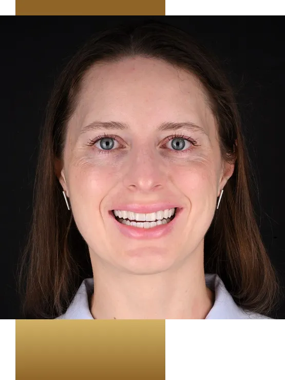 Brunette woman smiling with flawless teeth