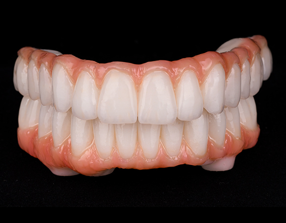Set of implant dentures against black background