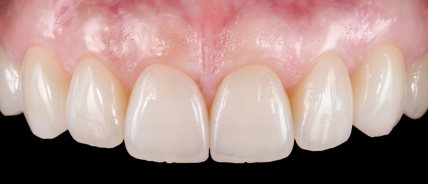 Close up of upper row of teeth