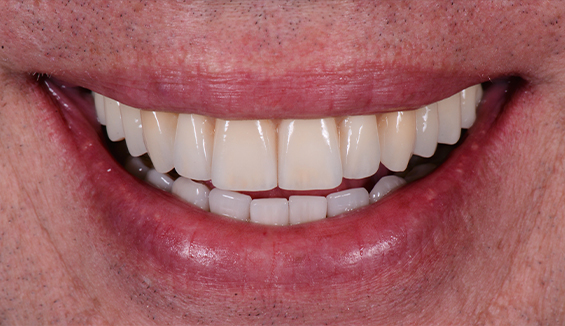 Close up of smile with straight white teeth