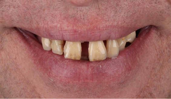 Close up of smile with gapped yellowed teeth