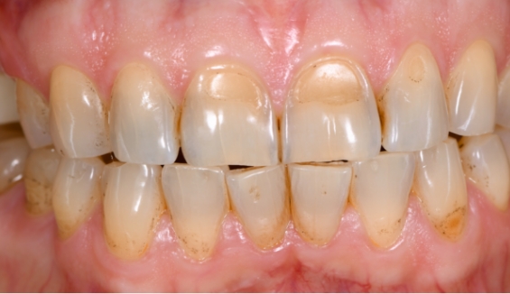 Close up of yellowed and slightly damaged teeth