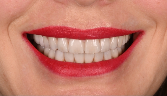 Close up of smile with straight white teeth