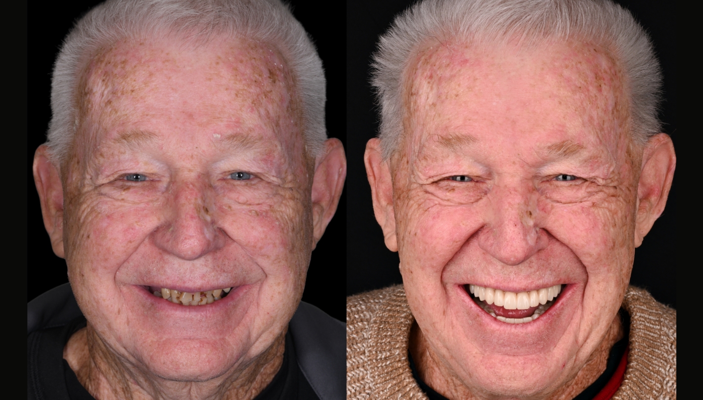 Senior man smiling before and after getting star concept full arch dental implants in Boston