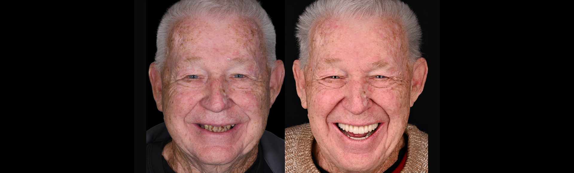 Senior man smiling before and after getting star concept full arch dental implants in Boston