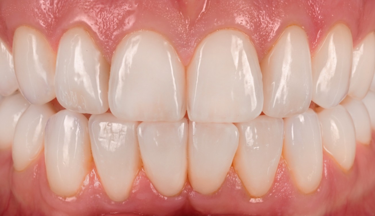 Close up of flawless teeth after dental services in Boston