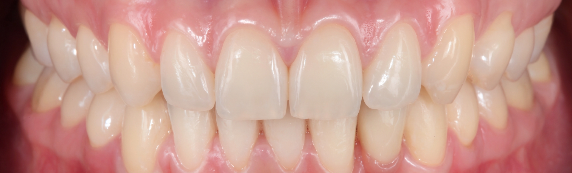 Close up of flawless teeth after dental services in Boston