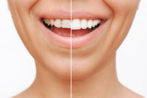 Before and after images of a woman showcasing her bright white teeth following a teeth whitening treatment.